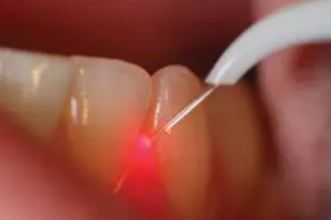 Dental Medical Diode Laser in use