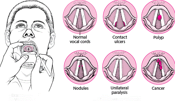 Laser Surgery for Vocal Cord Nodules’ Removal - Siflaser- by SIFSOF ...