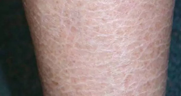 Laser Therapy for Fish Scale Disease - Siflaser- by SIFSOF, California